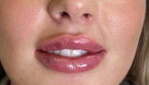 Lip Filler