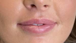 Lip Filler