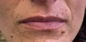 Lip Filler